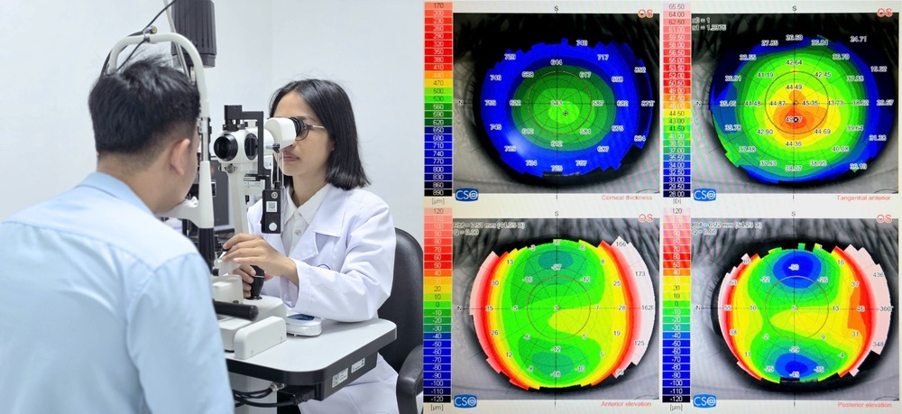 Phát hiện nhiều trường hợp giác mạc chóp ở người trẻ từ những bệnh nhân đo cắt kính thông thường - Ảnh 1.