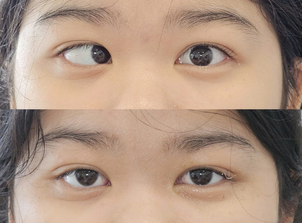 Lác (lé) mắt - có thể điều trị được không? - Ảnh 1.