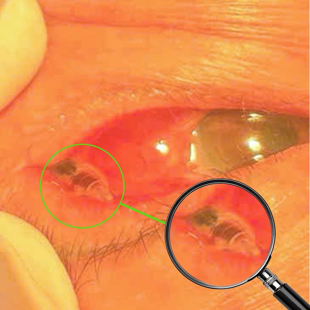 Phát hiện con ong bị kẹt trong mắt bệnh nhân hơn 24 giờ - Ảnh 1.