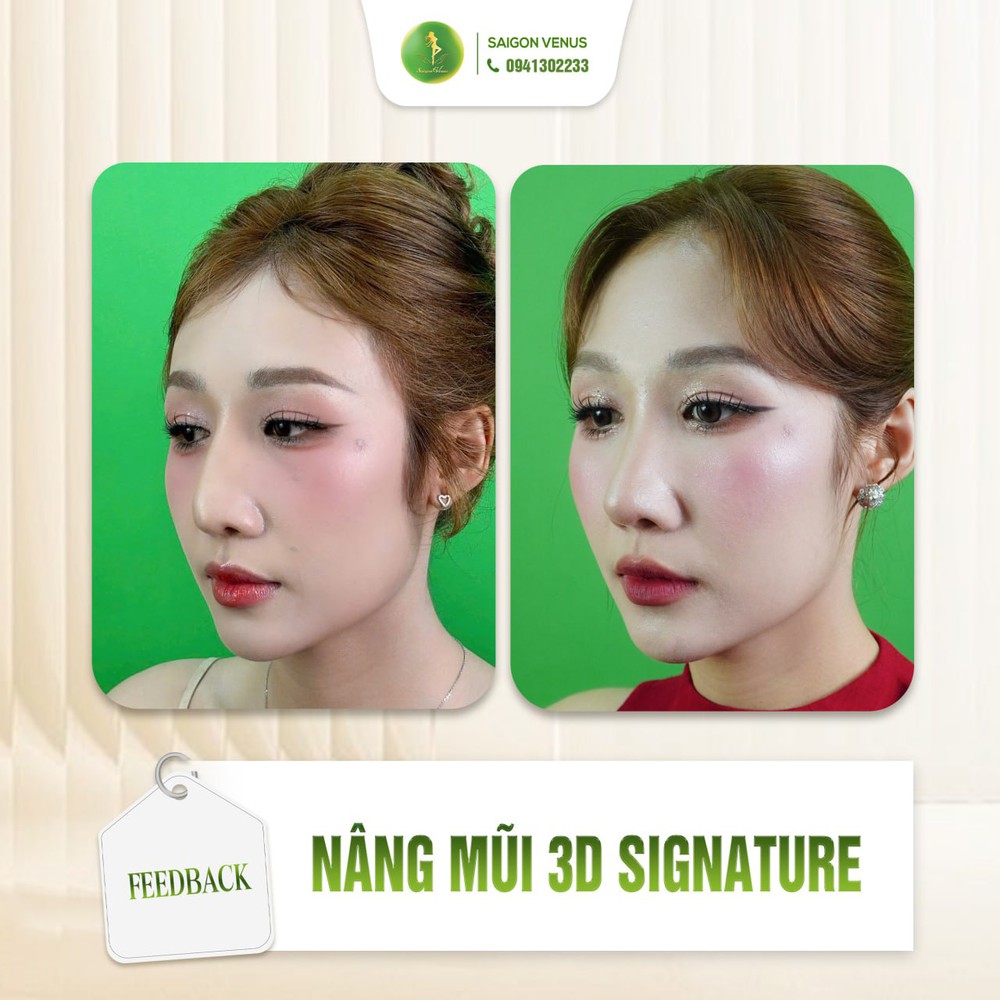 Saigon Venus phát triển công nghệ nâng mũi 3D Signature, hướng đến cá nhân hóa thẩm mỹ - Ảnh 2.