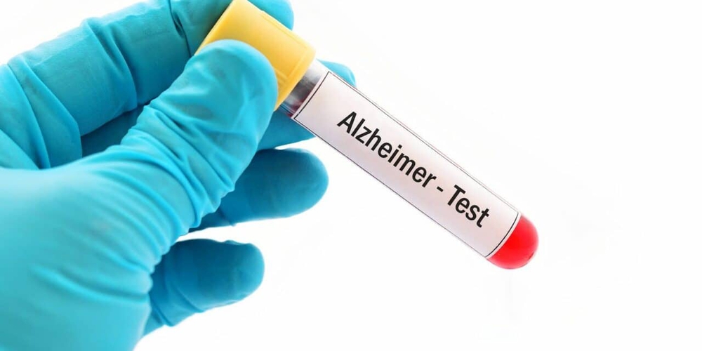 Bộ xét nghiệm máu mới giúp phát hiện sớm bệnh Alzheimer - Ảnh 1.
