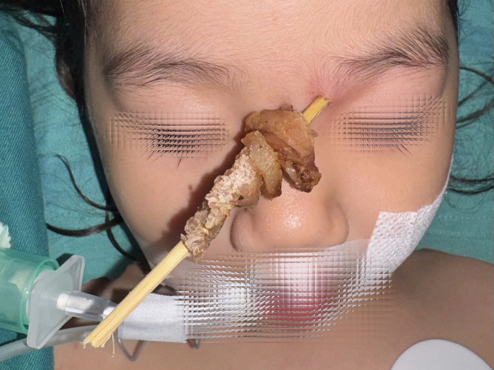 Thành công cứu bé gái bị que xiên thịt đâm xuyên nền sọ - Ảnh 1. Thành công cứu bé gái bị que xiên thịt đâm xuyên nền sọ - Ảnh 1.