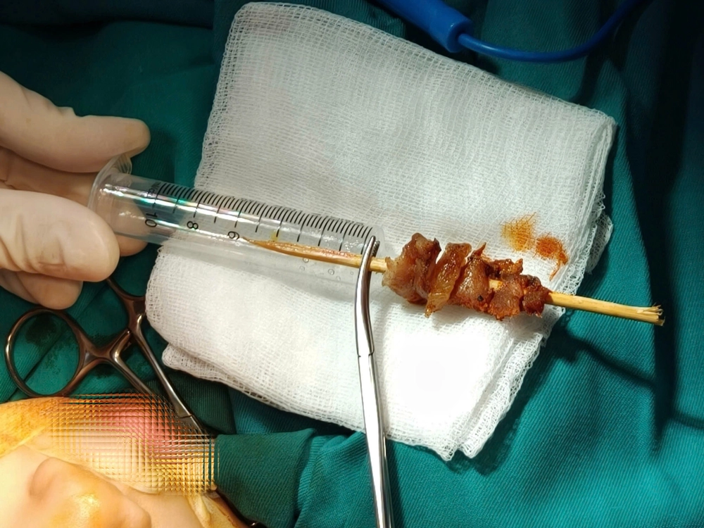 Thành công cứu bé gái bị que xiên thịt đâm xuyên nền sọ - Ảnh 2. Thành công cứu bé gái bị que xiên thịt đâm xuyên nền sọ - Ảnh 2.
