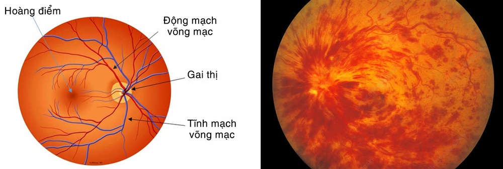 Tắc tĩnh mạch võng mạc  - Ảnh 1.