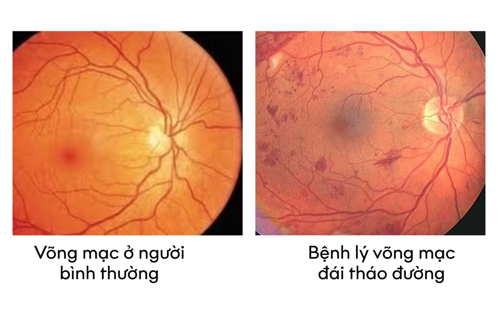Bệnh võng mạc đái tháo đường - chủ quan có thể dẫn đến biến chứng mù lòa - Ảnh 1.