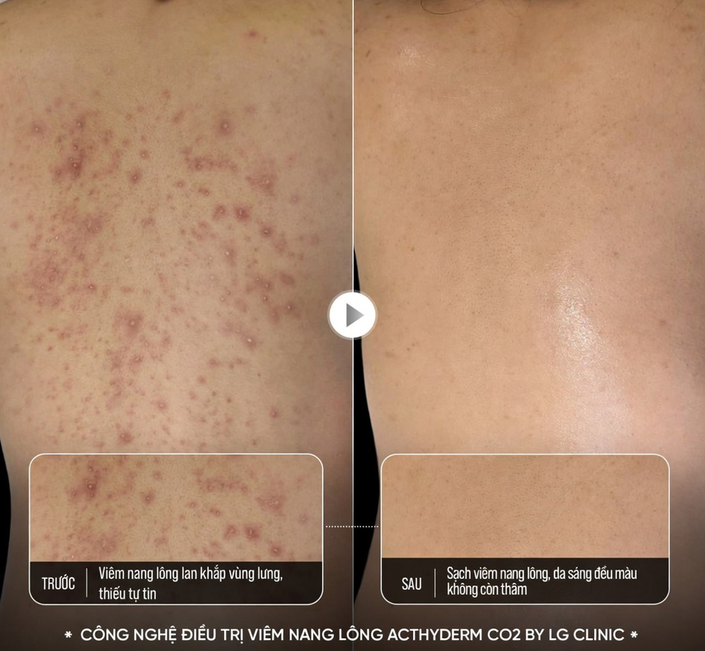 Cơ chế đột phá nào giúp Acthyderm – CO2 xóa sổ cả viêm nang lông, mụn lưng & thâm sần trong 1 liệu trình? - Ảnh 1.
