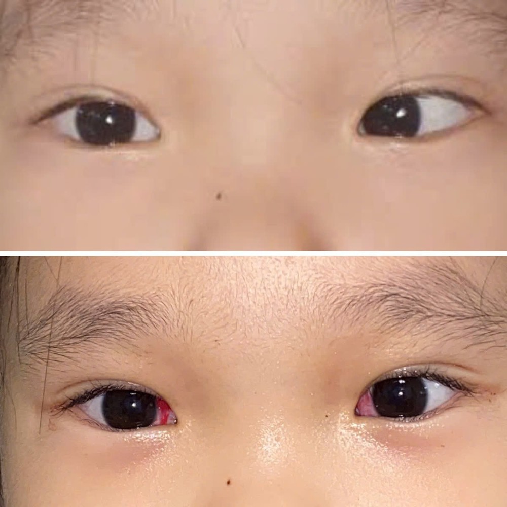 Phẫu thuật lác (lé) mắt có cần gây mê không? - Ảnh 1. Phẫu thuật lác (lé) mắt có cần gây mê không? - Ảnh 1.