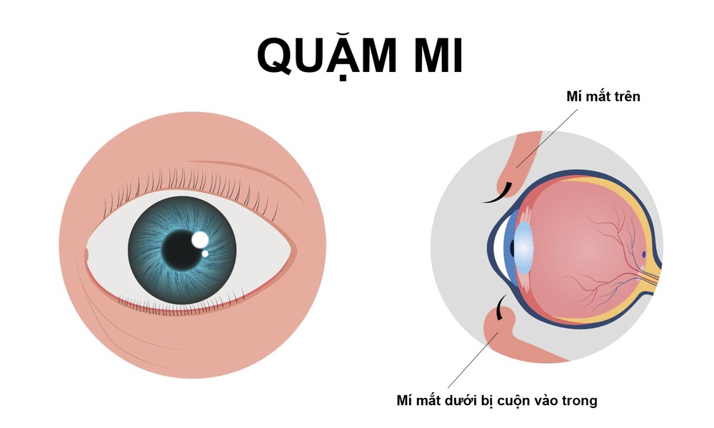 Quặm mi - khi lông mi âm thầm "cào xước" giác mạc mỗi ngày - Ảnh 1. Quặm mi - khi lông mi âm thầm "cào xước" giác mạc mỗi ngày - Ảnh 1.