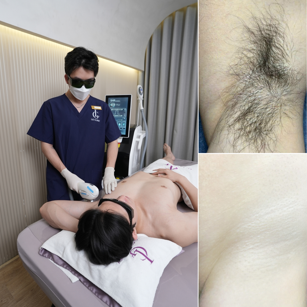 Triệt lông cho phái mạnh: Vì sao nam giới tập gym lựa chọn LG Clinic? - Ảnh 3. Triệt lông cho phái mạnh: Vì sao nam giới tập gym lựa chọn LG Clinic? - Ảnh 3.