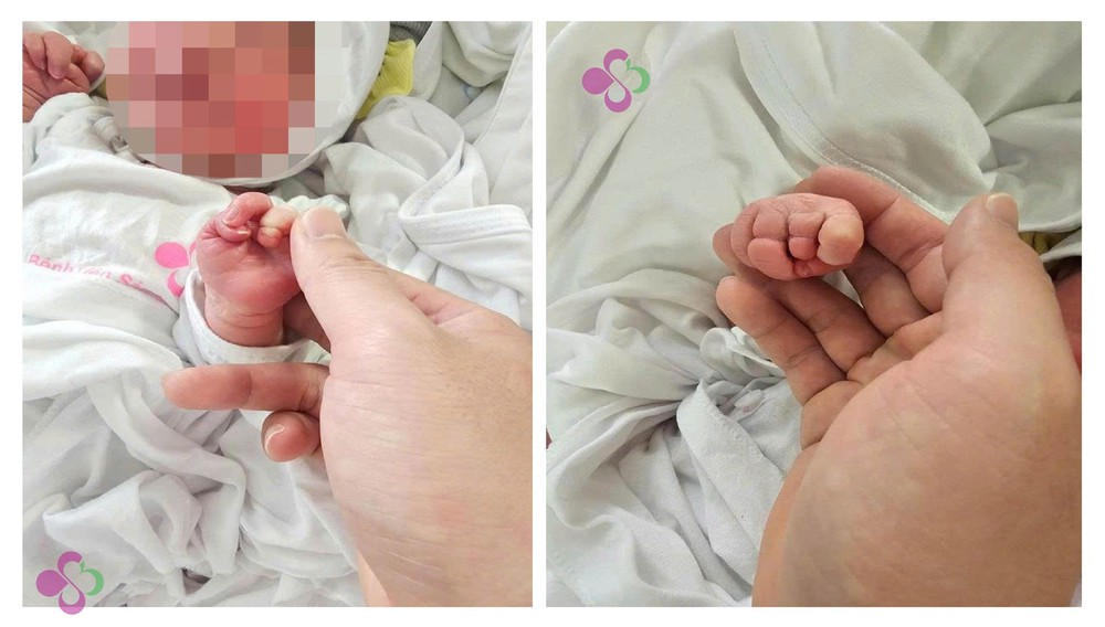 Phẫu thuật cứu cẳng chân bé sơ sinh 12 giờ tuổi bị dải sợi ối thắt nghẹt - Ảnh 2.
