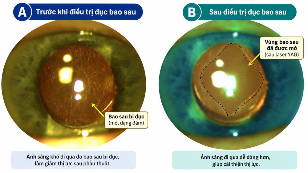 Đục bao sau: nguyên nhân giảm thị lực thường gặp sau mổ đục thể thủy tinh - Ảnh 1. Đục bao sau: nguyên nhân giảm thị lực thường gặp sau mổ đục thể thủy tinh - Ảnh 1.