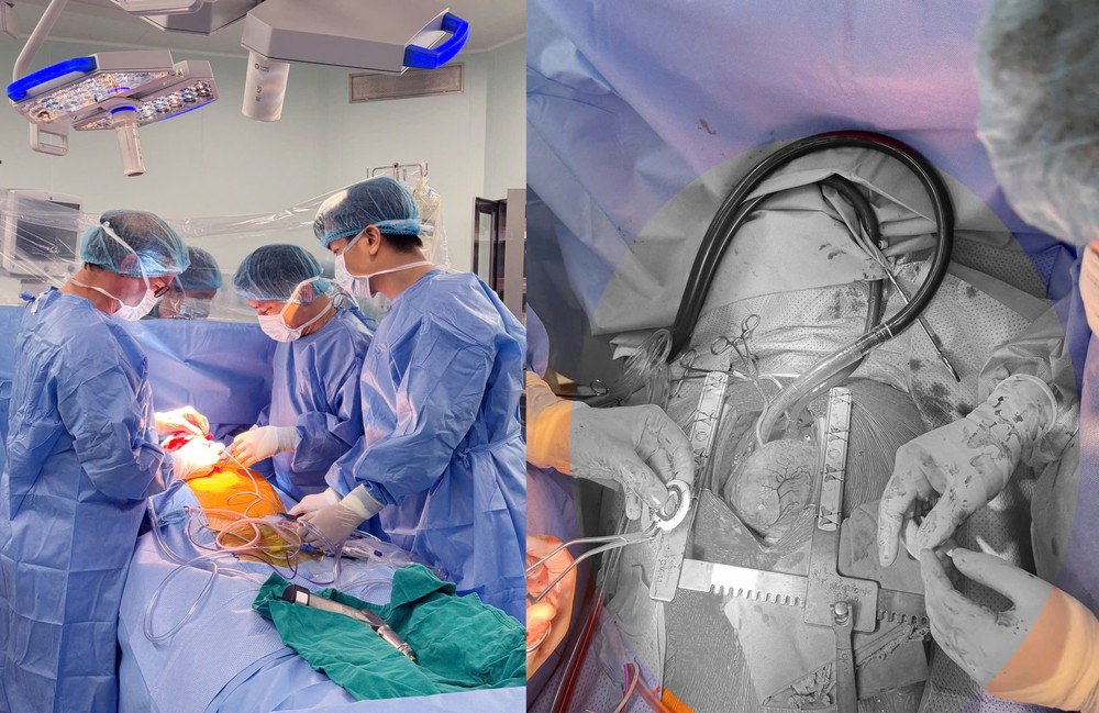 Bệnh viện TWQĐ 108 cấy ghép thành công thiết bị CorHeart 6 cho bệnh nhân suy tim giai đoạn cuối - Ảnh 1. Bệnh viện TWQĐ 108 cấy ghép thành công thiết bị CorHeart 6 cho bệnh nhân suy tim giai đoạn cuối - Ảnh 1.