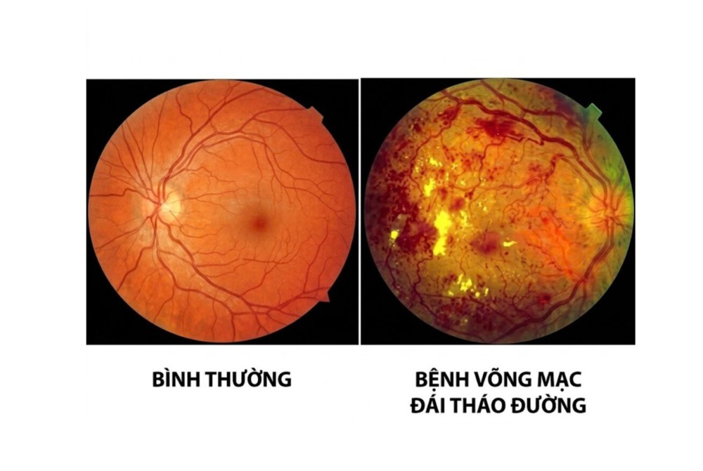 Bệnh lý võng mạc đái tháo đường và những biến chứng gây mù lòa - Ảnh 1.
