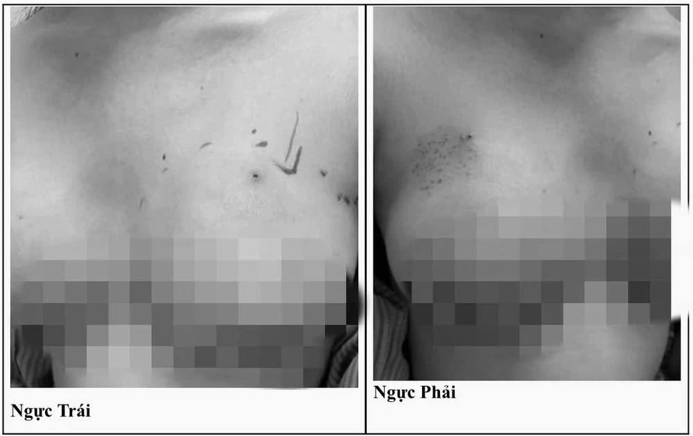 Ngực biến dạng, áp xe nặng sau khi tiêm filler tại nhà  - Ảnh 1.