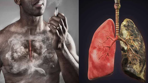 Bệnh viện K hướng dẫn công thức xác định nhóm nguy cơ cao mắc ung thư phổi