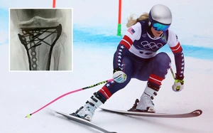 'Nữ hoàng trượt tuyết' Lindsey Vonn công bố hình ảnh X-quang kinh hoàng sau 5 ca phẫu thuật vì cú ngã ở Olympic mùa Đông