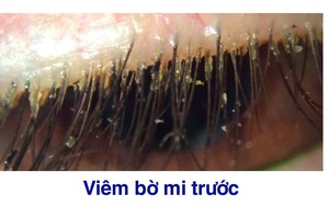 Bệnh lý viêm bờ mi