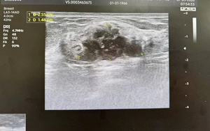 Phát hiện ung thư vú khi cơ thể vẫn "khỏe mạnh": Chuyên gia khuyến cáo tầm quan trọng của tầm soát sớm.