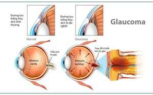 Phòng ngừa và phát hiện sớm bệnh Glôcôm