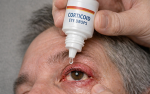 Hiệu quả và những lưu ý quan trọng khi sử dụng thuốc corticoid trong nhãn khoa