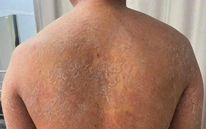 Suýt mất làn da khi tự chữa nấm bằng kem bôi không rõ nguồn gốc