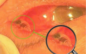 Phát hiện con ong bị kẹt trong mắt bệnh nhân hơn 24 giờ