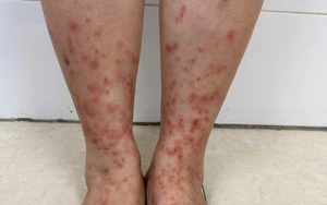 Viêm da do bọ chét gia tăng, cẩn thận sai lầm khi tự điều trị