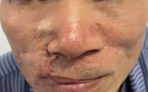 Ung thư da vẫn tái phát dù đã phẫu thuật nhiều lần?