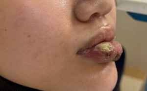 Nguy cơ hoại tử từ những mũi tiêm tan filler tại spa không được cấp phép