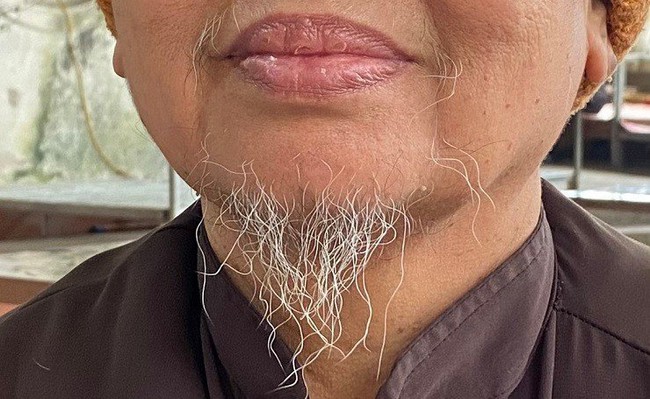    Lạ kỳ người phụ nữ Việt có bộ râu dài 8cm: 'Tôi coi đây là lộc trời cho' - Ảnh 1.