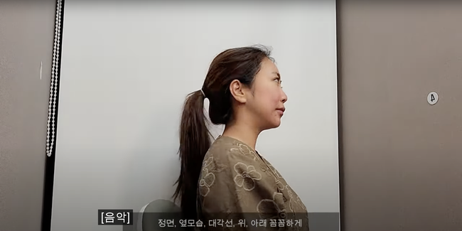 'Cháu gái' Song Hye Kyo gây sốc với chuyện sửa mũi: Đau đến không thở được, mới đầu tưởng hỏng mũi nhưng thành quả sau 3 tháng lại ưng ý vô cùng - Ảnh 4.