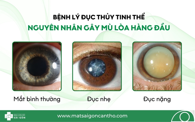 Cảnh báo bệnh về mắt nguy hiểm thường gặp ở người cao tuổi - Ảnh 2.