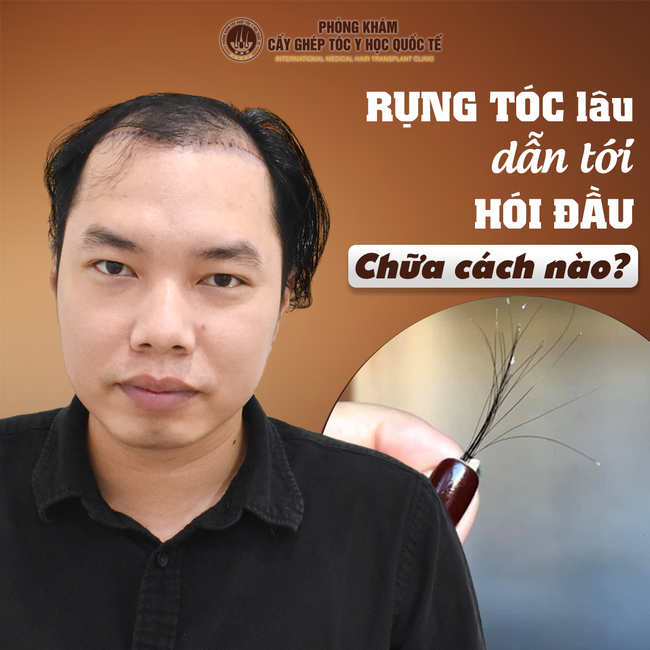 Khám phá công nghệ cấy tóc hiện đại tại Viện cấy tóc Quốc tế - Ảnh 1.