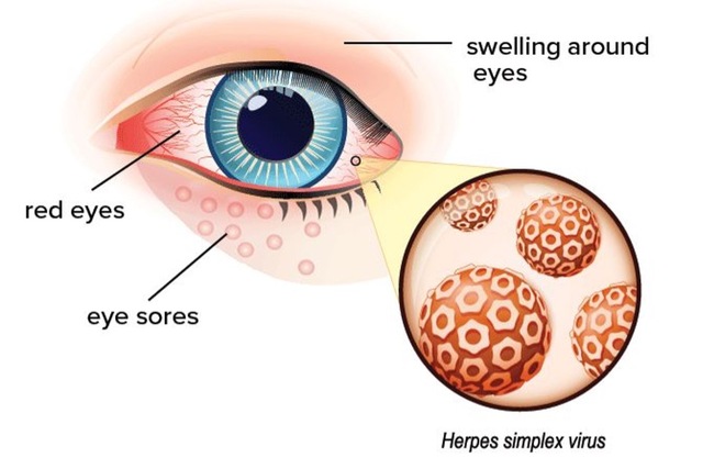Herpes mắt là gì? - Ảnh 1.