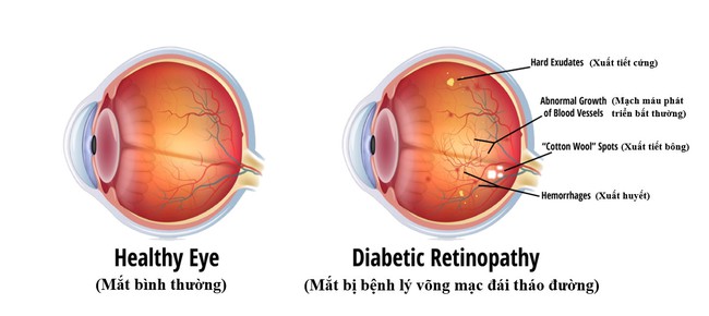 Bệnh lý võng mạc đái tháo đường (phần 1) - Ảnh 1.