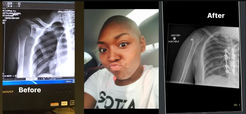 Cô gái 23 tuổi thường xuyên bị đau chân, cứ ngỡ do thừa cân gây nên: Đi khám phát hiện ung thư xương giai đoạn cuối, khối u lan khắp cơ thể không thể điều trị - Ảnh 2.