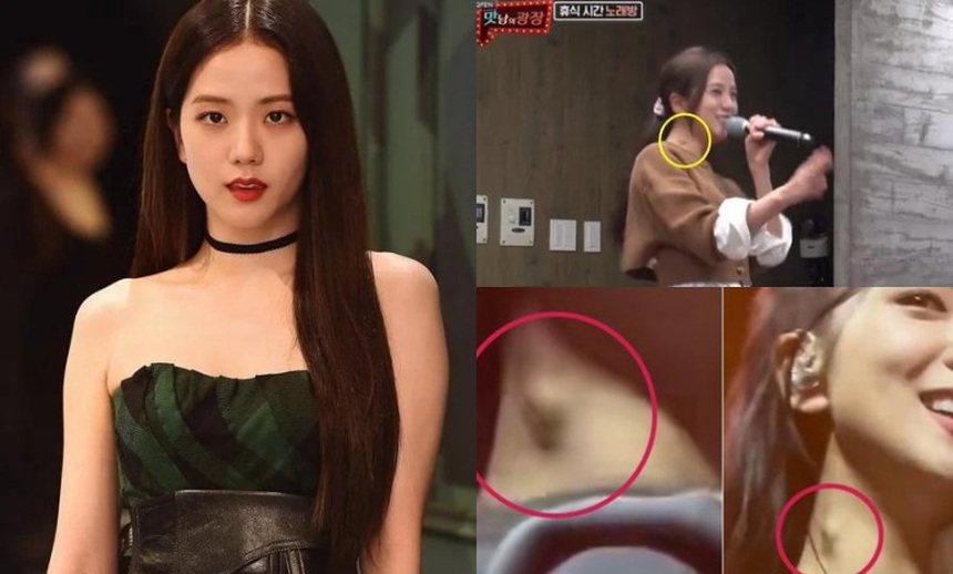 Đây không phải lần đầu tiên khối u xuất hiện