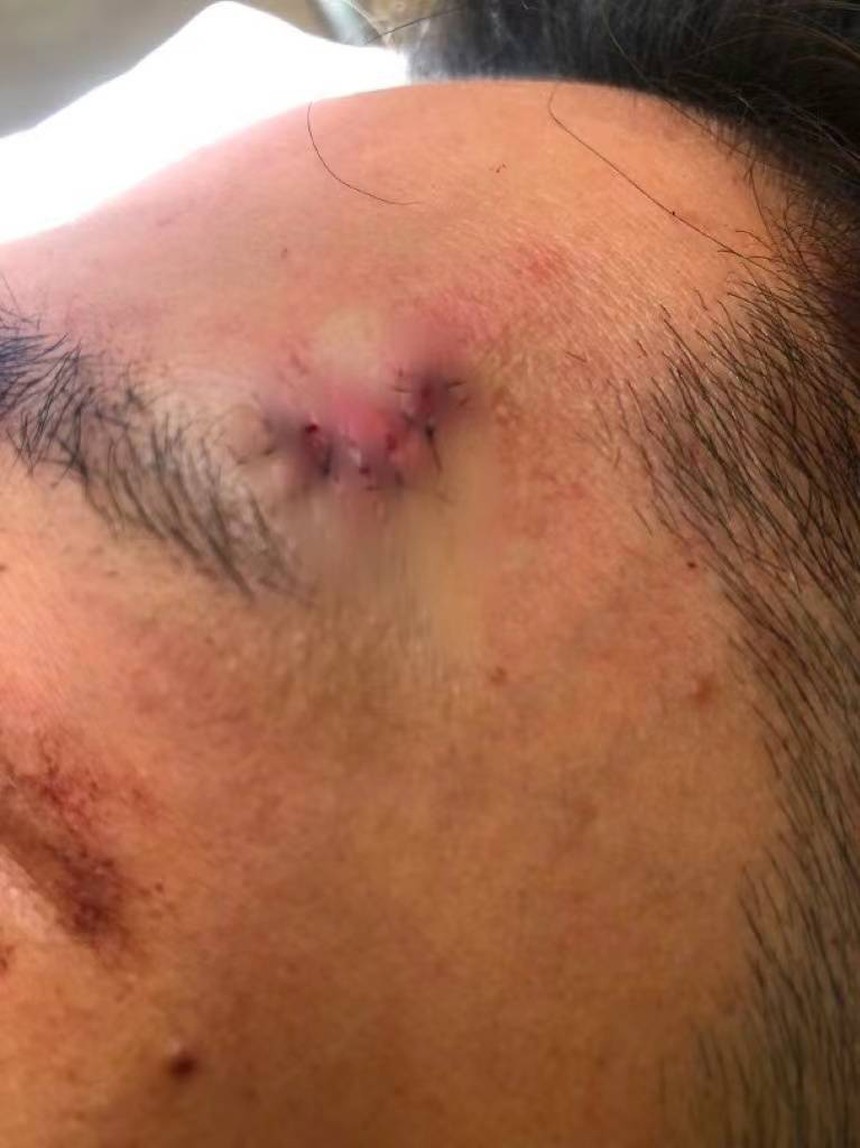 Sau 'nam thần thanh xuân' Kha Chấn Đông, thêm 1 mỹ nam có nguy cơ bị 'hủy dung' vì tai nạn phim trường nghiêm trọng! - Ảnh 2. Sau 'nam thần thanh xuân' Kha Chấn Đông, thêm 1 mỹ nam có nguy cơ bị 'hủy dung' vì tai nạn phim trường nghiêm trọng! - Ảnh 2.