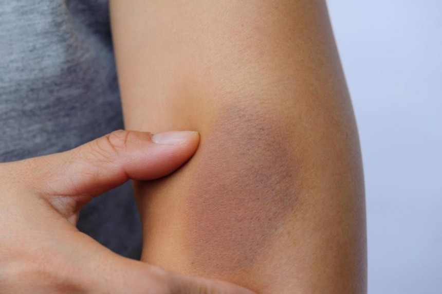 Bị côn trùng chích mấy tuần không lành, ông bố 3 con đi khám phát hiện mắc ung thư máu - Ảnh 4. Bị côn trùng chích mấy tuần không lành, ông bố 3 con đi khám phát hiện mắc ung thư máu - Ảnh 4.