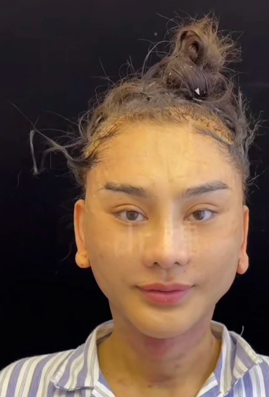 Lâm Khánh Chi kể tường tận quá trình căng da mặt, dân mạng nghe mà 'hết hồn' - Ảnh 2.