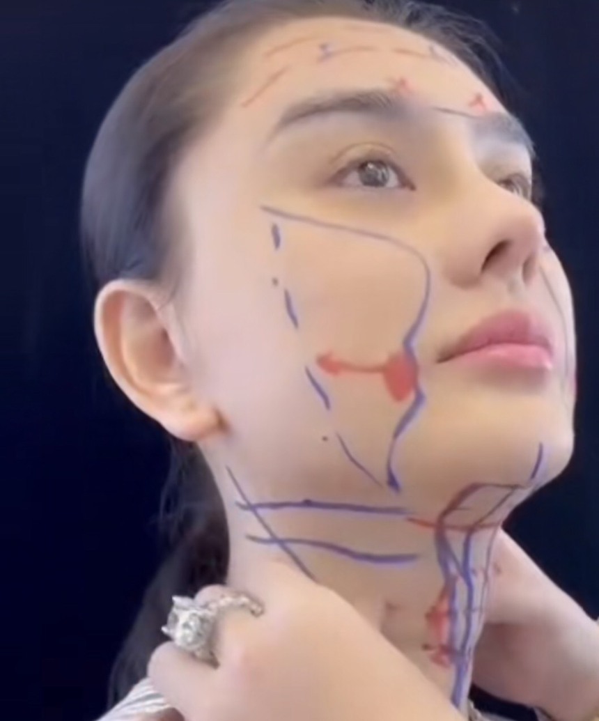 Lâm Khánh Chi kể tường tận quá trình căng da mặt, dân mạng nghe mà 'hết hồn' - Ảnh 1.