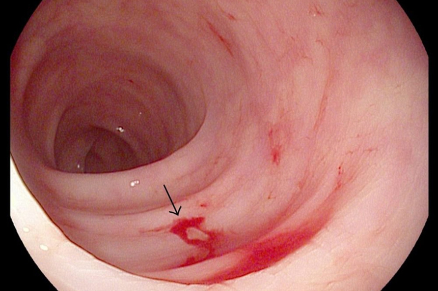 Thứ biết hại nhưng nhiều người khó từ chối là nguyên nhân gây chảy máu, mòn dạ dày sớm - Ảnh 1.