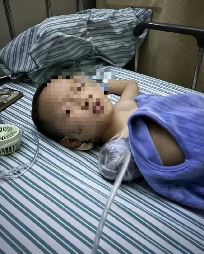 "Mẹ ơi, con đau chết mất" - cậu nhóc 7 tuổi đang chơi trước nhà nhưng bị cắt cụt tay, bóng ma tâm lý đi theo suốt đời vì một sai lầm của hàng xóm - Ảnh 1. "Mẹ ơi, con đau chết mất" - cậu nhóc 7 tuổi đang chơi trước nhà nhưng bị cắt cụt tay, bóng ma tâm lý đi theo suốt đời vì một sai lầm của hàng xóm - Ảnh 1.