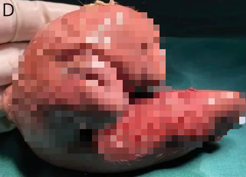 Mang thai đôi nhưng chỉ sinh một bé, 1 năm sau bố mẹ đưa con gái đi khám mới phát hiện sự thật đáng sợ nằm trong não - Ảnh 3. Mang thai đôi nhưng chỉ sinh một bé, 1 năm sau bố mẹ đưa con gái đi khám mới phát hiện sự thật đáng sợ nằm trong não - Ảnh 3.