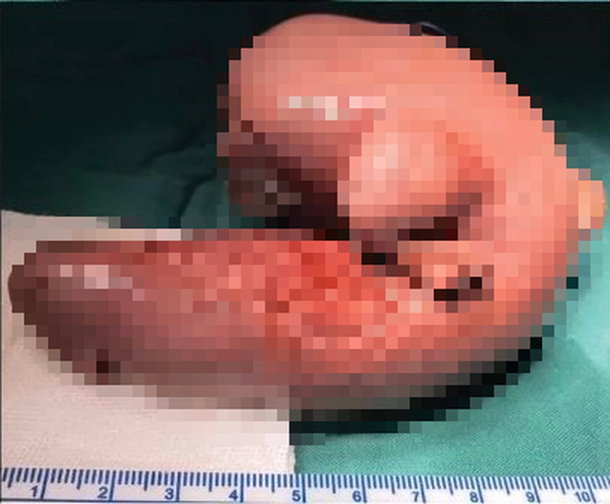 Mang thai đôi nhưng chỉ sinh một bé, 1 năm sau bố mẹ đưa con gái đi khám mới phát hiện sự thật đáng sợ nằm trong não - Ảnh 4. Mang thai đôi nhưng chỉ sinh một bé, 1 năm sau bố mẹ đưa con gái đi khám mới phát hiện sự thật đáng sợ nằm trong não - Ảnh 4.