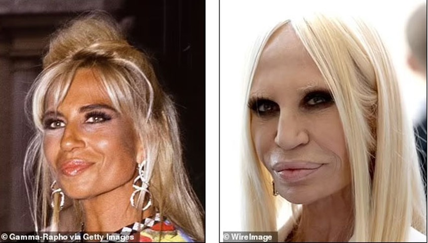 Theo đuổi vẻ trẻ trung mà đánh mất đi khuôn mặt của chính mình - Những celeb phẫu thuật thẩm mỹ khiến fan choáng váng - Ảnh 11.