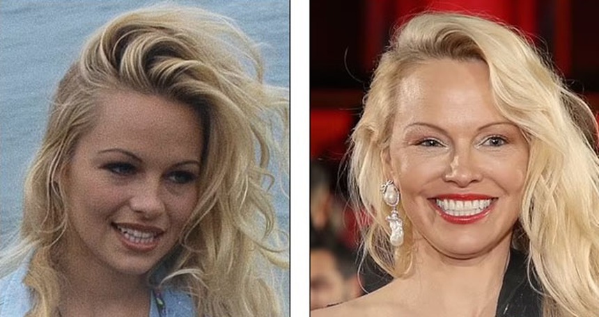 Theo đuổi vẻ trẻ trung mà đánh mất đi khuôn mặt của chính mình - Những celeb phẫu thuật thẩm mỹ khiến fan choáng váng - Ảnh 4.