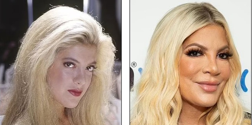 Theo đuổi vẻ trẻ trung mà đánh mất đi khuôn mặt của chính mình - Những celeb phẫu thuật thẩm mỹ khiến fan choáng váng - Ảnh 6.