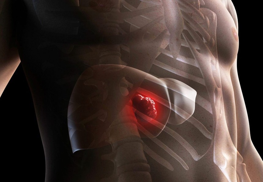 Đợi triệu chứng mới đi khám ung thư gan là đã muộn, cách đơn giản chỉ điểm bệnh sớm ai cũng cần biết - Ảnh 1. Đợi triệu chứng mới đi khám ung thư gan là đã muộn, cách đơn giản chỉ điểm bệnh sớm ai cũng cần biết - Ảnh 1.