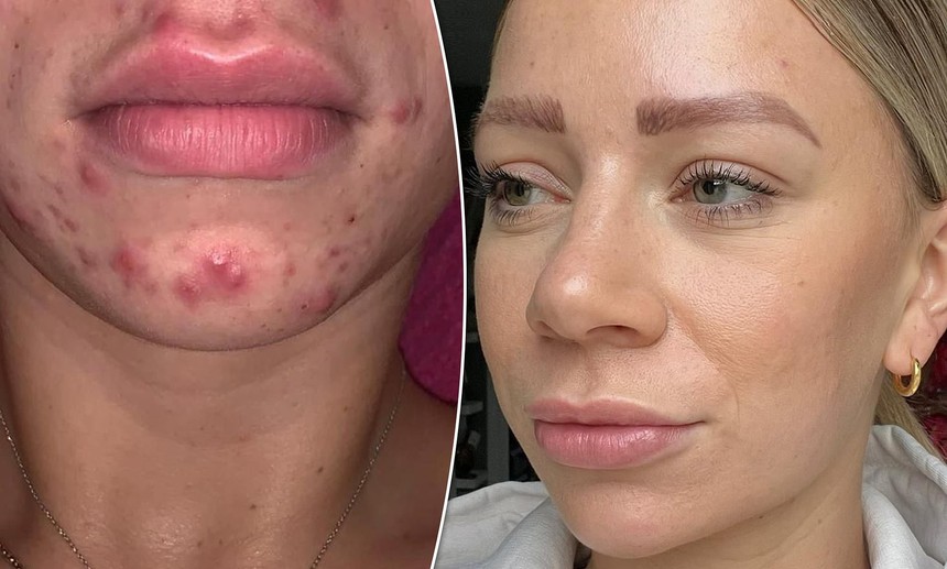 Gác lại Retinol dễ gây kích ứng vì 2023 là lúc 5 hoạt chất thay thế sau lên ngôi - Ảnh 1.